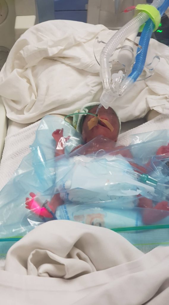 25 week micro preemie