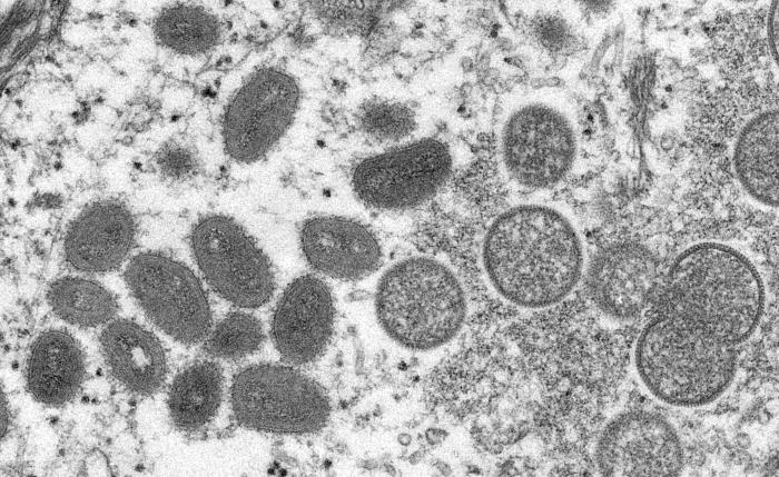 3rd monkeypox case in PH recovers