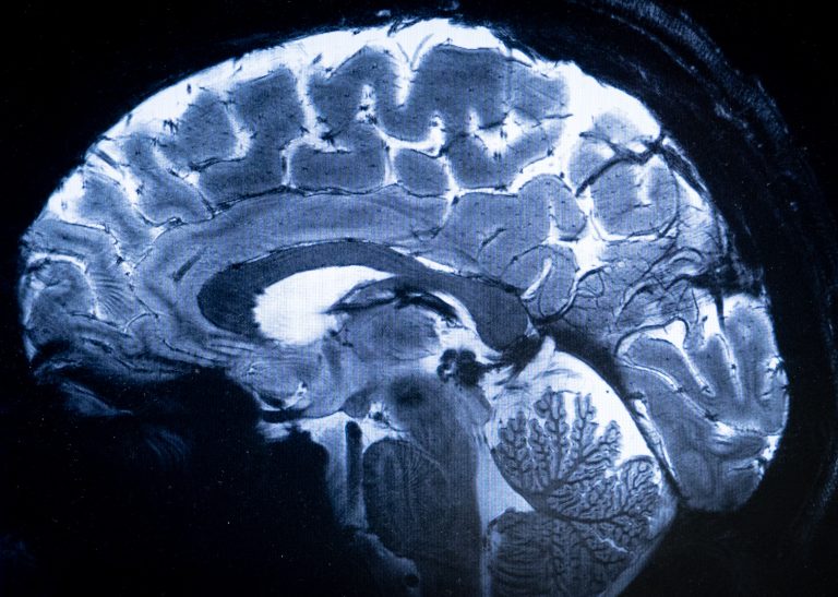 World’s most powerful MRI scans first images of human brain